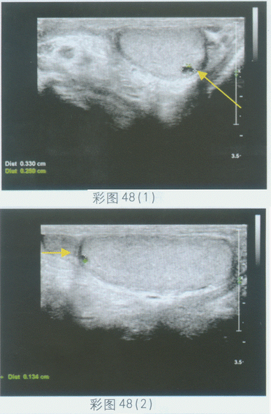 临床资料：男，55岁，自诉阴囊不适。超声综合描述：左侧睾丸形态、大小正常，可见数个无回声区，边界清晰