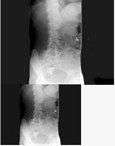 女，47岁，腰背痛并向髋部和下肢放射，结合图像，最可能的诊断是（）