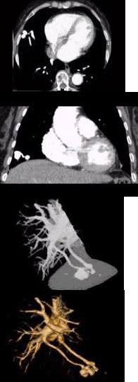 请看一组肺血管的CT增强图像，考虑最可能的诊断为()