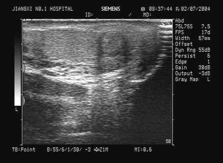 某患者左侧阴囊下部疼痛不适3天，曾患前列腺炎，无外伤史，无结核病史，超声声像图如下，最可能的诊断为（