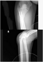女，55岁，跌倒后右手痛，结合X线平片表现，正确的诊断是（）