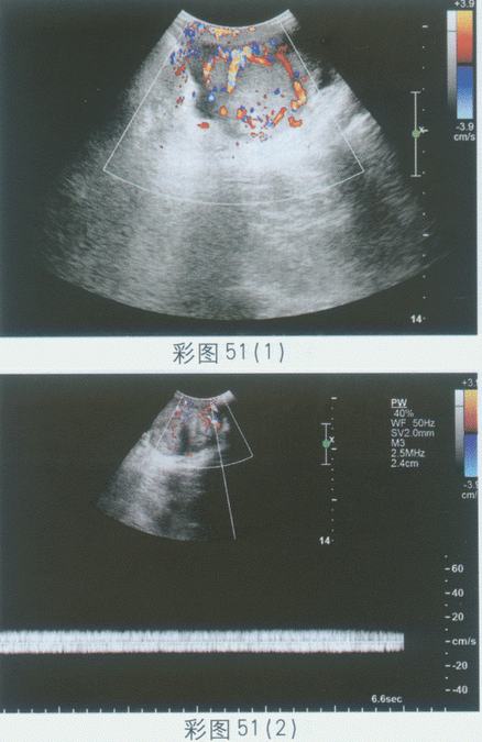 临床资料：男，40岁，自述左侧阴囊肿大。超声综合描述：左侧睾丸大小7.7cm×5.5cm，失常态，边