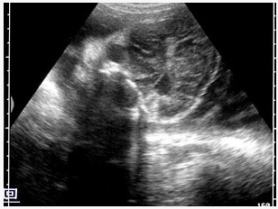 晚孕胎儿脑部声像图，最可能的诊断是（）。