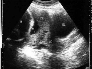女，25岁，停经37周，阴道不规则出血来院就诊，B超检查声像图如图所示，最可能的诊断为（）。