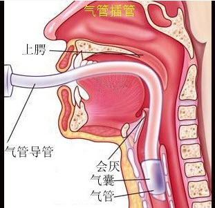 低压大容量套囊特点是（）	A. 注气后成圆柱状B. 注气后成梭形球状C. 与气管接触面大D. 套囊内