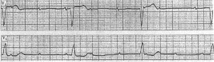 患者男性，72岁，急性下壁心肌梗死病史。心电图如图所示，应诊断为（）