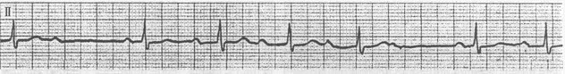 患者女性，26岁，偶发胸闷、心悸。心电图如图所示，应诊断为（）