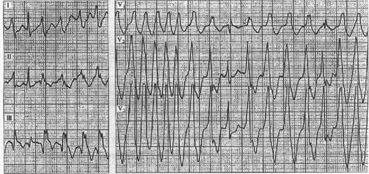 患者男性，49岁。因心悸、胸闷，晕厥1次就诊。心电图如图所示，应考虑为（）