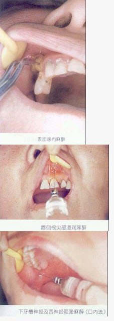 松动的乳牙拔除宜采用的麻醉方法是（）