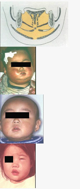 婴幼儿颌下间隙感染常继发于（）