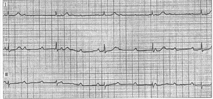 患者女性，32岁，胸闷、头昏症状。心电图如图所示，应诊断为（）