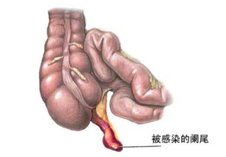 如图为妊娠合并阑尾炎。随着妊娠周数增加，阑尾的位置向什么方向移动()