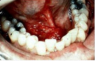 男，40岁，发现右侧口底部有一核桃大小质硬肿块（如图），触诊浸润已过中线。右侧颌下可扪及2个肿大淋巴