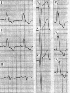 患者男性，28岁，主动脉狭窄。心电图如图所示，应诊断为（）