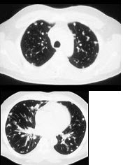 女，72岁，咳嗽，胸闷，呼吸困难1月余，1年前行结肠癌根治术，CT检查如图，请选择最可能的诊断()