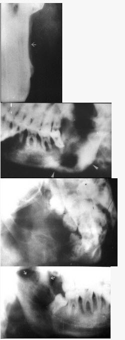 在颌骨骨髓炎中，哪一种可发现多个牙松动及疼痛（）