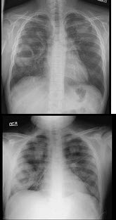 男，35岁，发热，贫血，血尿，既往有副鼻窦炎，结合X线图像，最可能的诊断是()