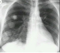 女，48岁，胸痛1周，结合影像图像选择最可能的诊断为()