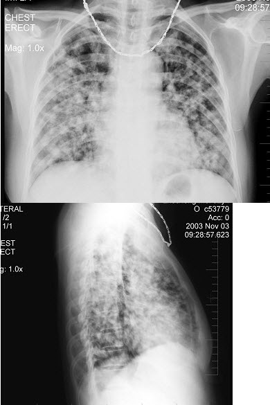 女性，52岁，感胸痛2个月，发热，X线检查如图，最可能的诊断是()