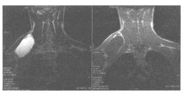 男性，22岁，发现右颈部肿物5年，逐渐增大，无痛。体检：肿物囊性感，压之凹陷，无压痛。MRI平扫图像