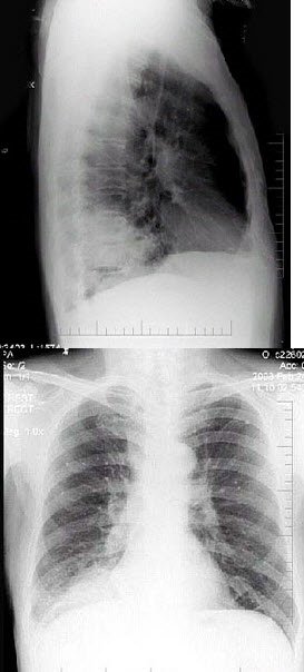男性，62岁，咳嗽、胸痛1月，X线检查如图，最佳的诊断是()