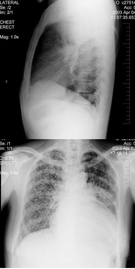 女性，63岁，感胸痛、呼吸困难2个月，咳嗽、发热2天，曾有肺癌手术史，X线检查如图，最可能的诊断是(