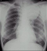 女，25岁，胸背痛2周，胸片如图，最可能的诊断为()
