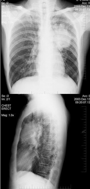 女性，51岁，胸痛数月，痰血2天，X线检查见图，最可能的诊断是()