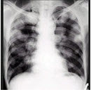 男，45岁，HBV阳性10年，胸痛1个月伴咳嗽，咯血1天，胸片如图，选择最可能的诊断()
