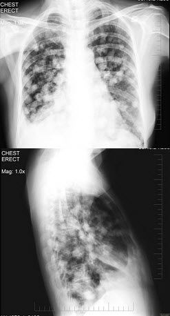 女性，53岁，胸闷乏力数月，偶感胸痛，不发热，X线检查如图，最可能的诊断是()