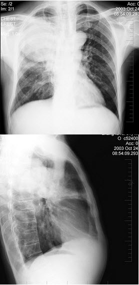 男性，61岁，胸痛数月，近两天痰中带血，X线检查如图，最可能的诊断是()