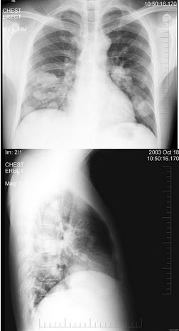 男性，43岁，胸闷、胸痛10余天，不咳嗽不发热，X线检查如图，最合理的诊断是()