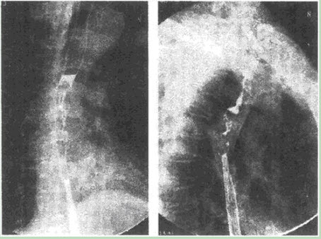 患者男性，58岁，吞咽困难2月余，X线图像如下，最有可能的诊断是（）。