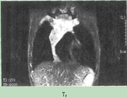 患者男性，15岁，胸闷胸痛2月，伴低热月余，患者行MR扫描图像如下，最有可能的诊断是（）。