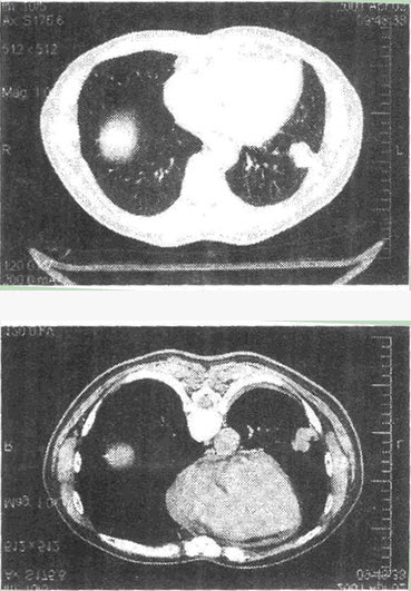 患者男性，54岁，出现反复咳嗽咳痰3月，CT线图像如下，最有可能的诊断是（）。
