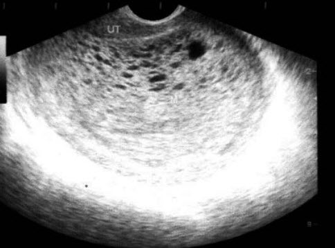 患者女24岁，停经2月余阴道不规则出血数日，阴式B超检查声像图如图所示，应诊断为()