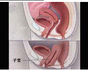 对于图中所示的子宫脱垂，如为老年女性，治疗原则应为________、________和_______