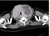 青年女性，咽异物感1年，环状软骨左下方触及一直径2厘米的光滑结节，随吞咽上下活动，生长缓慢，颈部CT