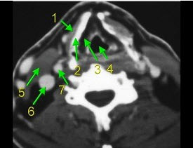 下面是一颈部CT图，其中结构标志不正确的是（）。