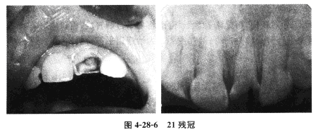 患者，女，56岁，职员。	主诉：左上前牙缺损多年，要求修复。	现病史：多年前左上前牙发黑，且出现冷热