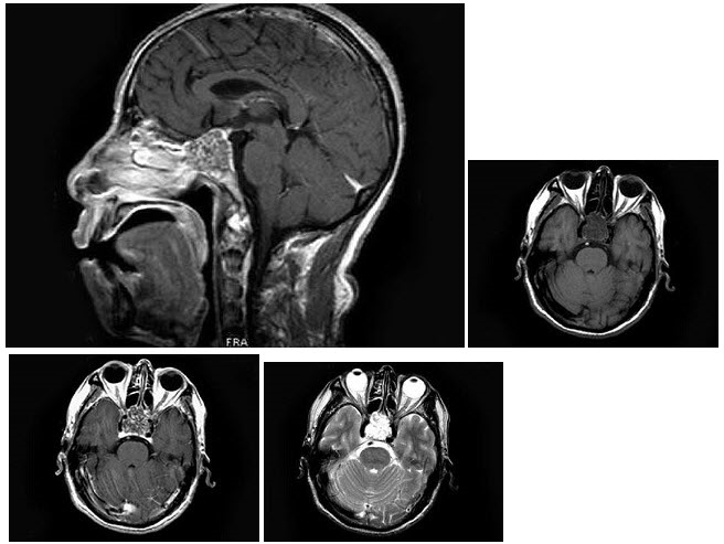 男67岁头痛5个月ct及mri检查见斜坡骨质破坏最可能的诊断为