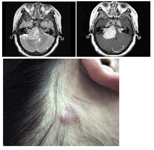 女，22岁，双侧听力下降伴头痛头昏近10年，根据所提供图像，最可能的诊断是（）