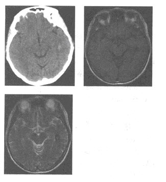 女性，49岁，发作性头晕4小时余。查体：神清语利，颅神经（-），高血压病史5年。CT及MRI检查如图