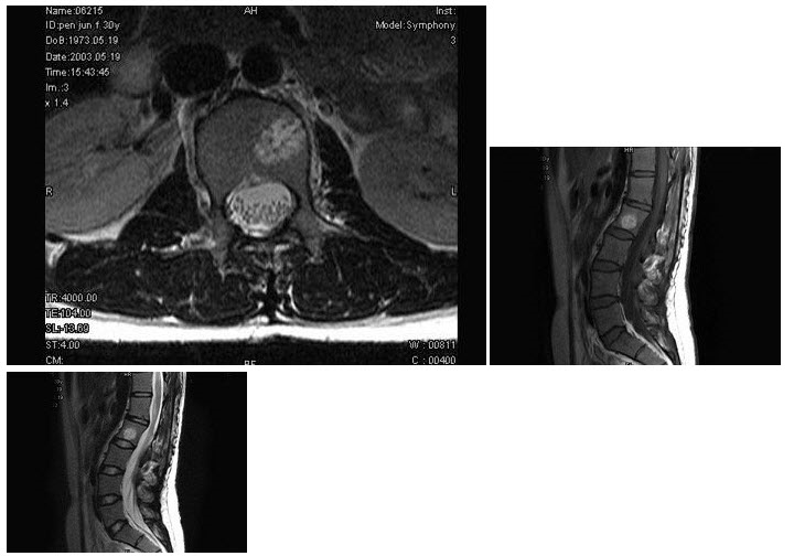 女，30岁，腰痛2个月，MRI检查见L椎体类圆形异常信号最可能的诊断是（）
