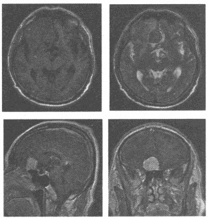 女性，74岁。头痛半年余。实验室检查正常。颅脑MRI平扫及增强扫描如下图，最可能的诊断为（）