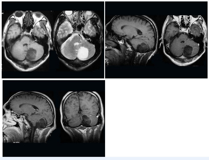 男，42岁，头痛2年，加重1个月，MRI检查如图，最可能的诊断为（）