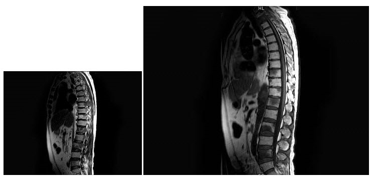 男，71岁，腰背部疼痛1月余，MRI扫描见脊柱多发骨质破坏，最可能的诊断是（）