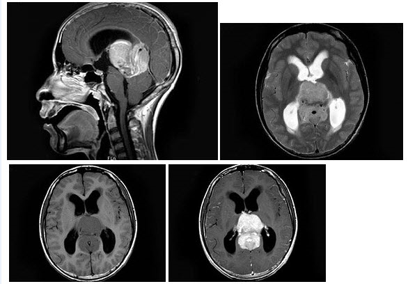 男，16岁，头痛数月，MRI平扫及增强扫描如图，最可能的诊断是（）