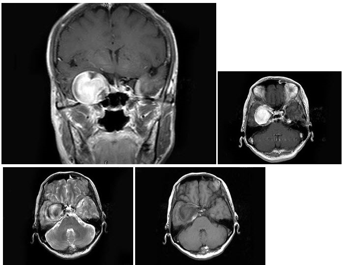 女，62岁，头痛数年，头颅MRI检查如图，最可能的诊断是（）