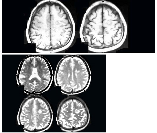 男，42岁，头痛1个月余，MRI检查如图，最可能的诊断为（）